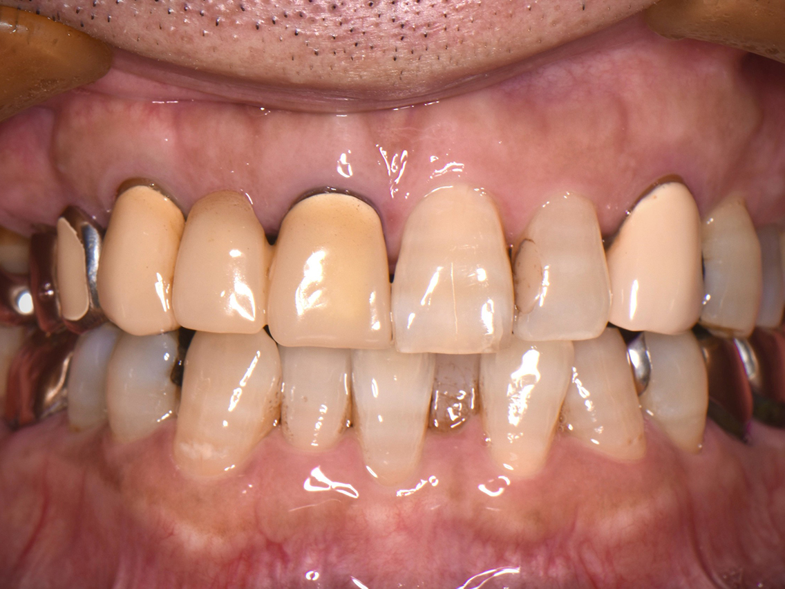 インプラントの症例01治療前
