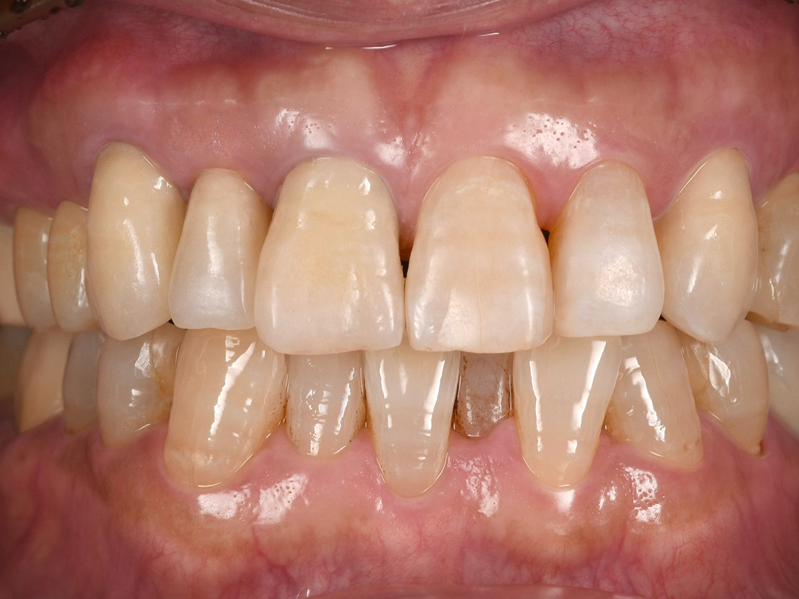 インプラントの症例01治療後