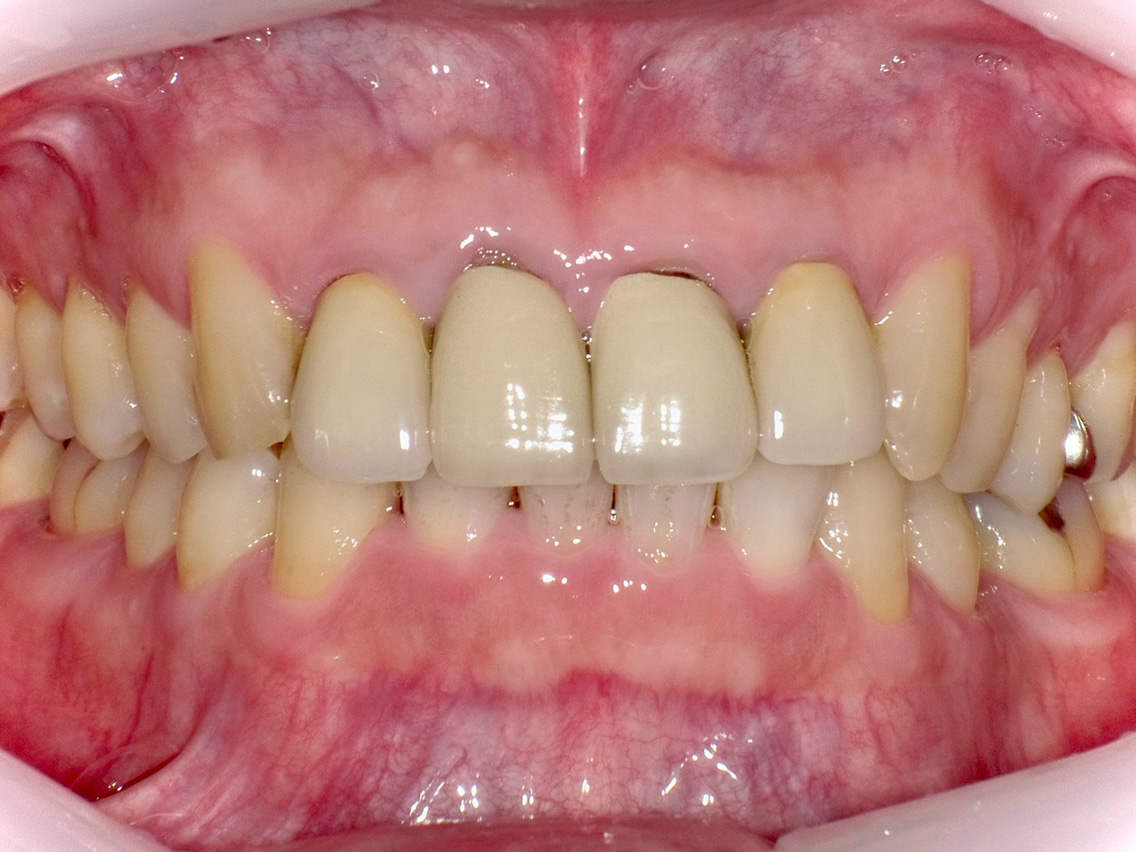 インプラントの症例02治療前