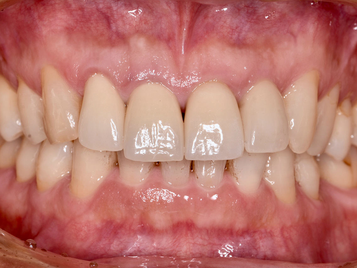 インプラントの症例02治療後